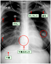 レントゲンへの金属の写り方の例の画像